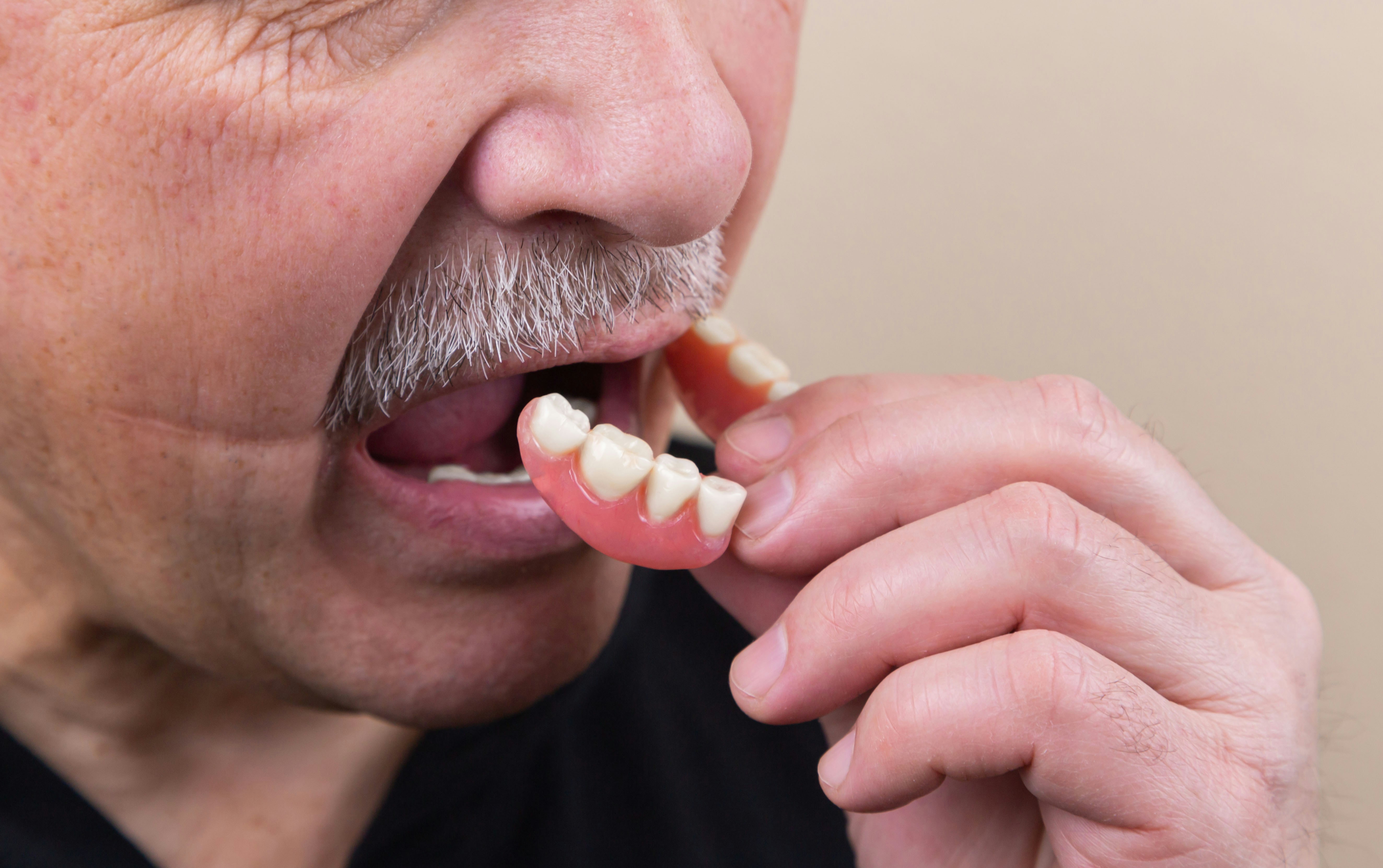 Răng sứ tháo lắp – Dòng răng tháo lắp cao cấp hiện nay  